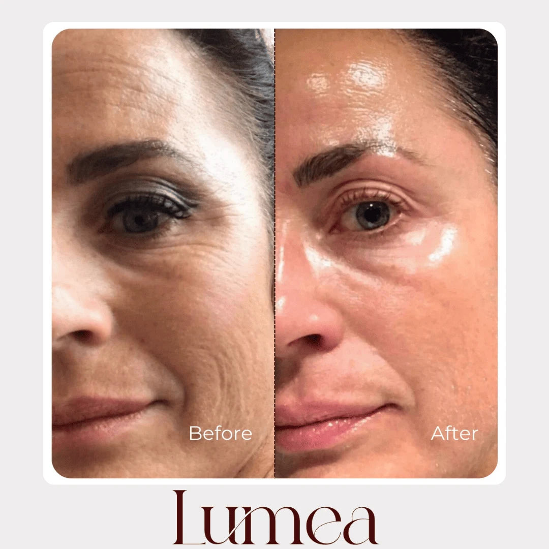 Before and after under-eye comparison showing brighter, smoother-looking skin with Lumea skincare