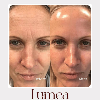 Before and after face comparison showing brighter, smoother-looking skin with Lumea renewal skincare