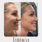 Before and after side profile comparison showing smoother-looking smile lines with Lumea skincare