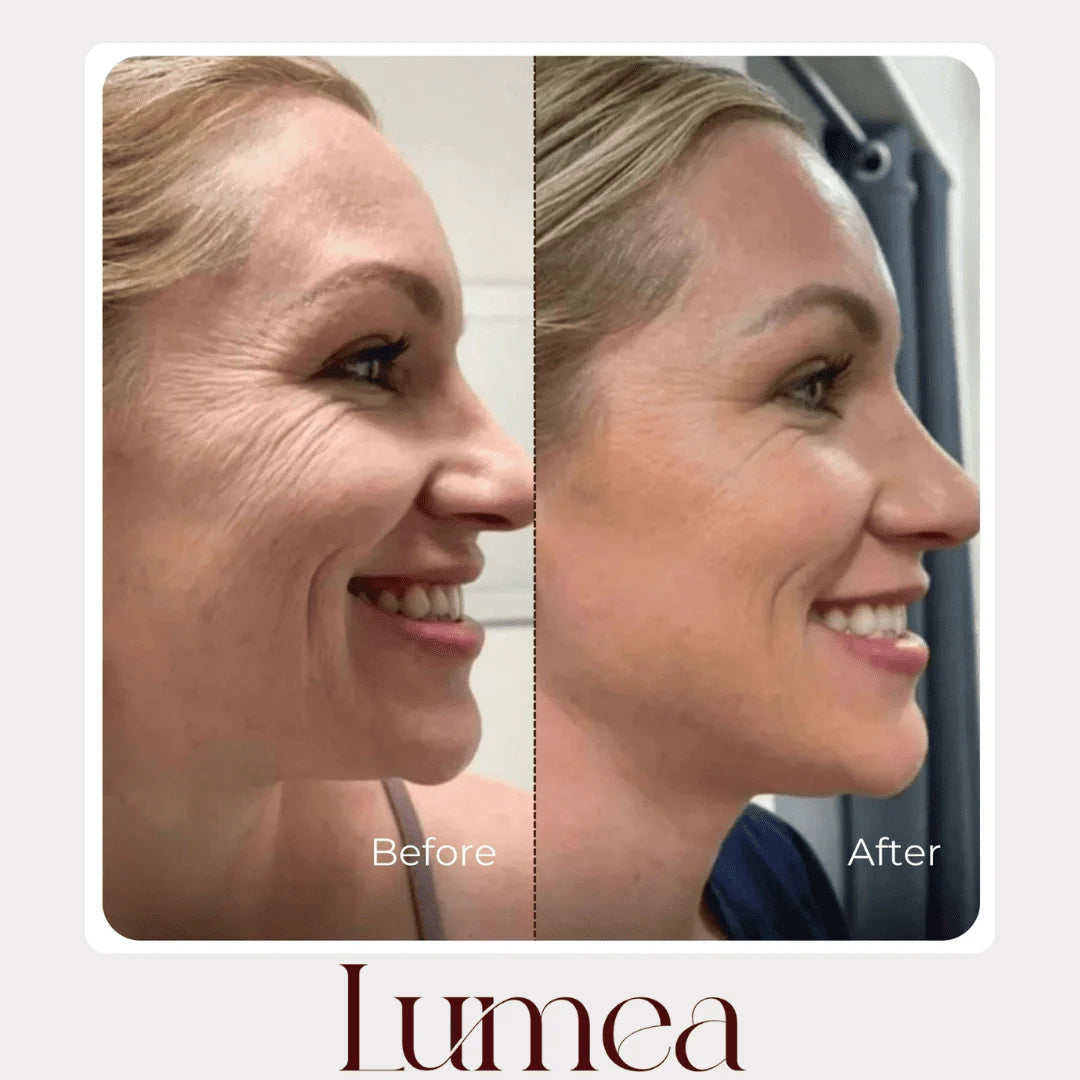 Before and after side profile comparison showing smoother-looking smile lines with Lumea skincare