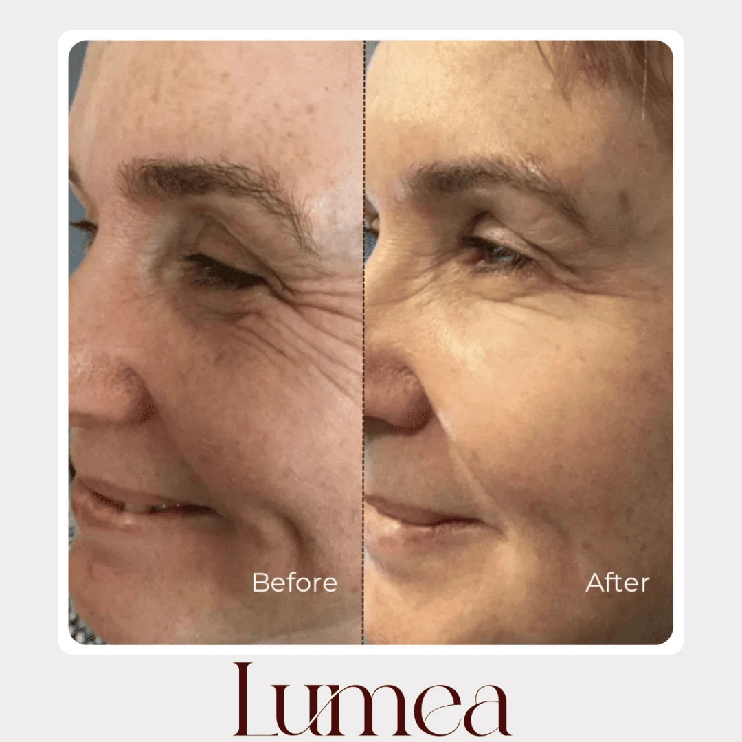 Before and after eye area comparison showing smoother-looking skin with Lumea skincare