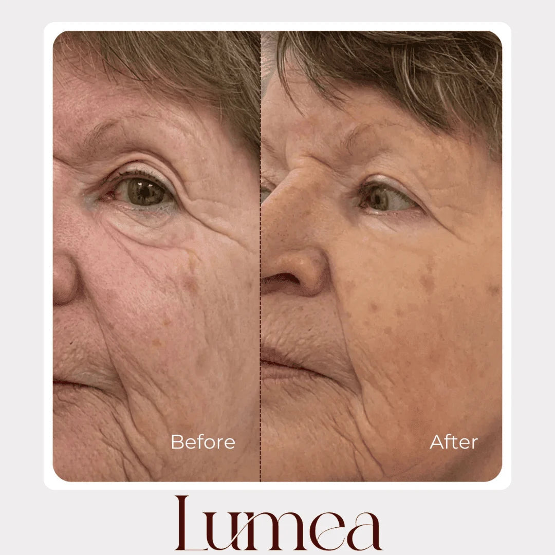Before and after mature skin comparison showing improved-looking texture with Lumea skincare